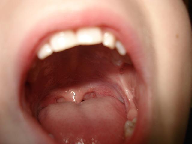 Zapalenie Blony Sluzowej Jamy Ustnej Medicaldiet Pl