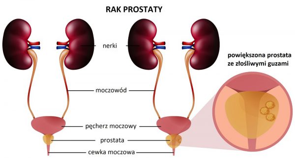 Rysunek przedstawiający powiększenie pęcherza moczowego i prostaty w przypadku choroby