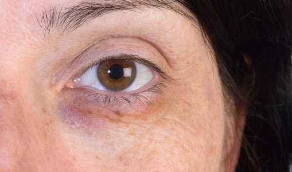 Kobieta stosowała okłady z lodu w miejscu uszkodzenia naczyń krwionośnych, aby podbite oko nie było bardzo widoczne