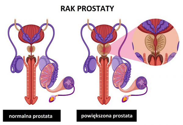 Powiększony rozrost prostaty to jedna z niebezpiecznych chorób wieku starczego