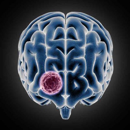 Zdjęcie przedstawia guza mózgu