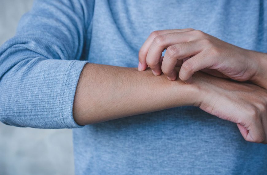 Mężczyzna drapie się po ręce w miejscu, gdzie wystąpiły objawy świerzbu