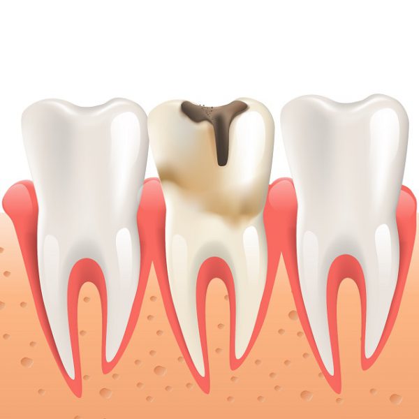 Próchnica Zębów Przyczyny Rodzaje Leczenie Zapobieganie 2722