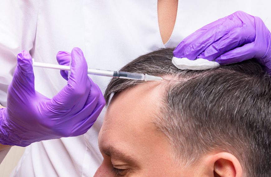 Przeszczep włosów – wszystko co musisz wiedzieć