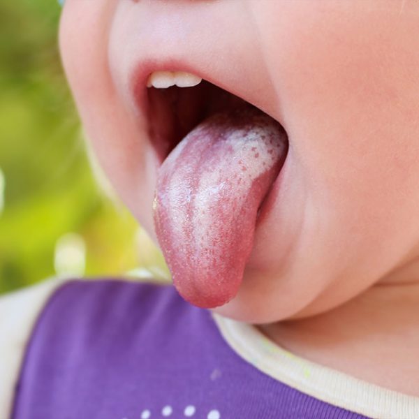 Infekcja grzybicza jamy ustnej objawia się jasnym nalotem na języku małej dziewczynki