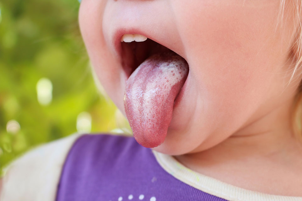 Infekcja grzybicza jamy ustnej objawia się jasnym nalotem na języku małej dziewczynki