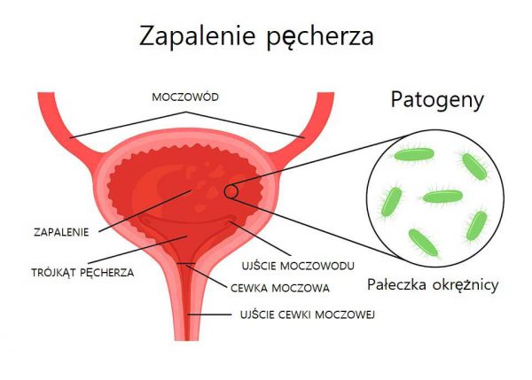 Częste oddawanie moczu leczenie domowe - Przyczyny i profilaktyka