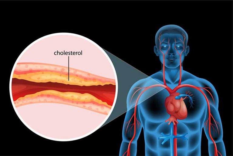 Czyszczenie żył W Nogach Jak Pozbyć Się Cholesterolu Z żył 9414