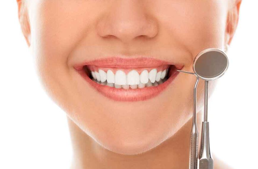 Bonding zębów — co to jest